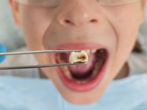 Best Broken Tooth Emergency  in Mccormick, SC